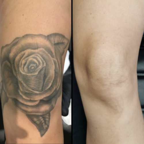 Fjernelse af tatovering - En tryg og effektiv behandling